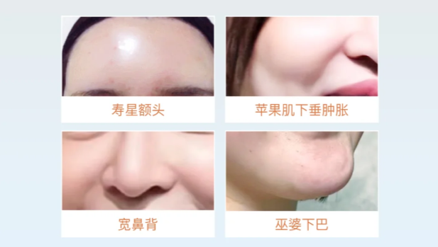 关于韩可旺是否有整容失败实例,在馒化修复方面,我还真没找到有吐槽的