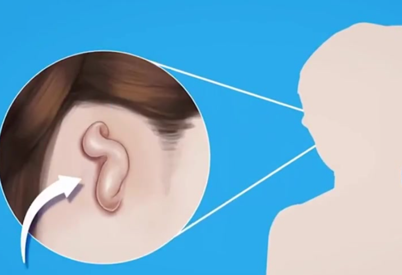 北京杨庆华小耳畸形再造手术费用