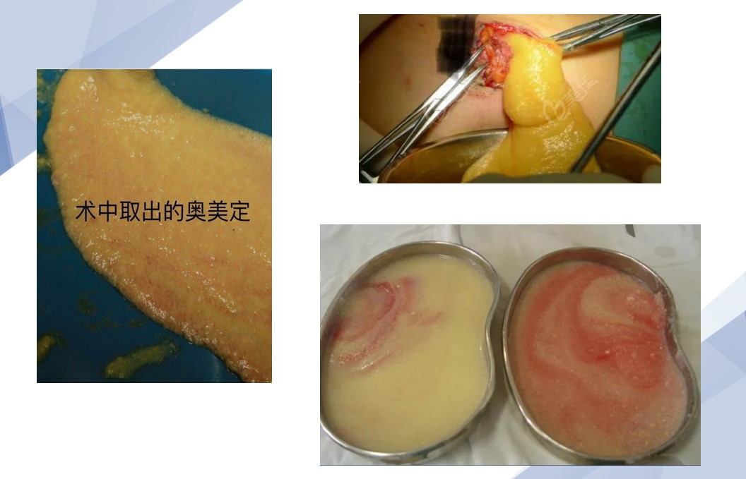 华奥美定隆胸取出
