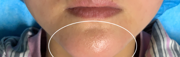 取生长因子的常见疑问——刘文阁医生的患者都问什么?