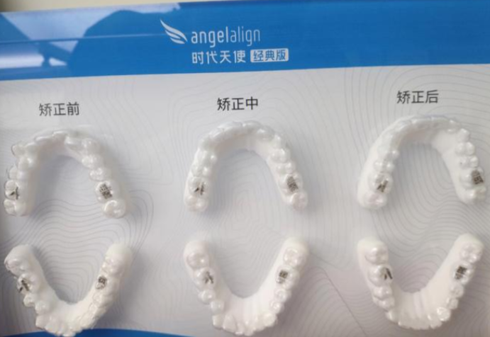 任蕾正畸做时代天使吗?价格与方案对比