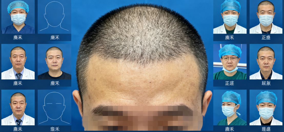 雍禾正规还是碧莲盛正规?两家都正规,对比技术:雍禾微针vs碧莲盛不剃发效果