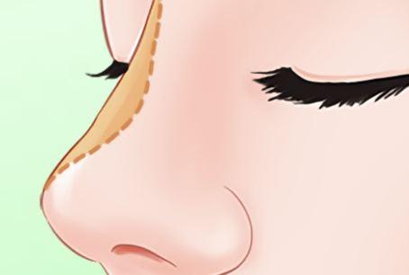 在杭州做肋骨鼻哪家好？艺星-连天美-薇琳-美莱做肋骨鼻技术靠谱