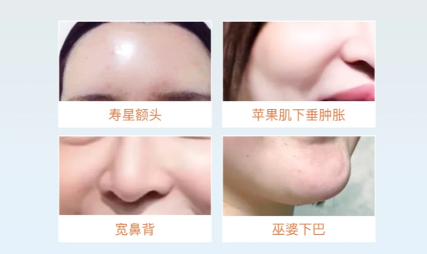 找韩可旺医生做馒化提升,这些细节要注意