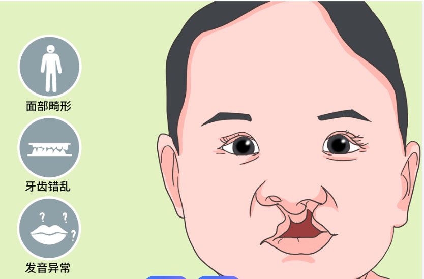 兔唇二次修复住院多久?简单手术3 - 5天 复杂手术或超7天 术后消肿1月到3月