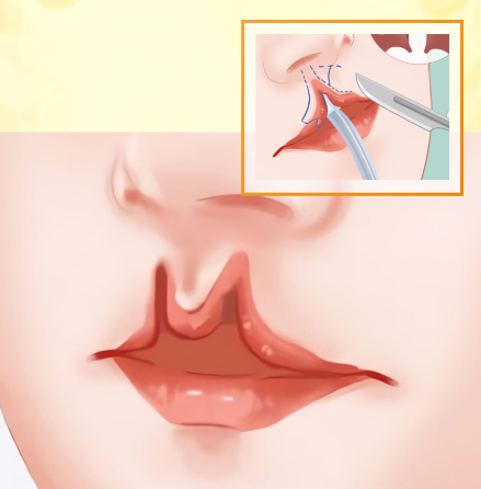尹宁北医生唇裂修复手术排期公示啦!今日08:00开始可预约至2026年01月28日的号源