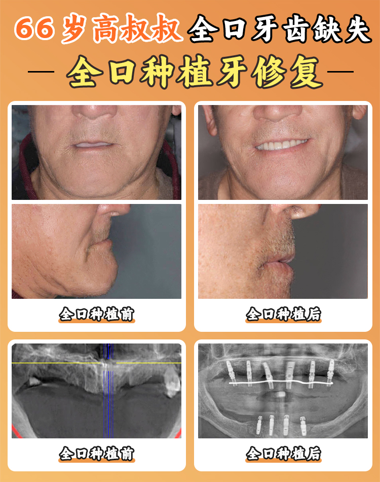 贝臣口腔医院种植牙1800元是真的吗？集采叠加优惠是实价，种牙靠谱可放心！ 