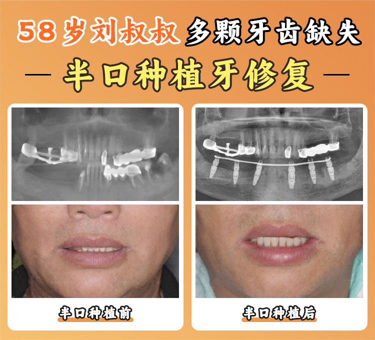 一、贝臣口腔医院种植牙1800元的真实性