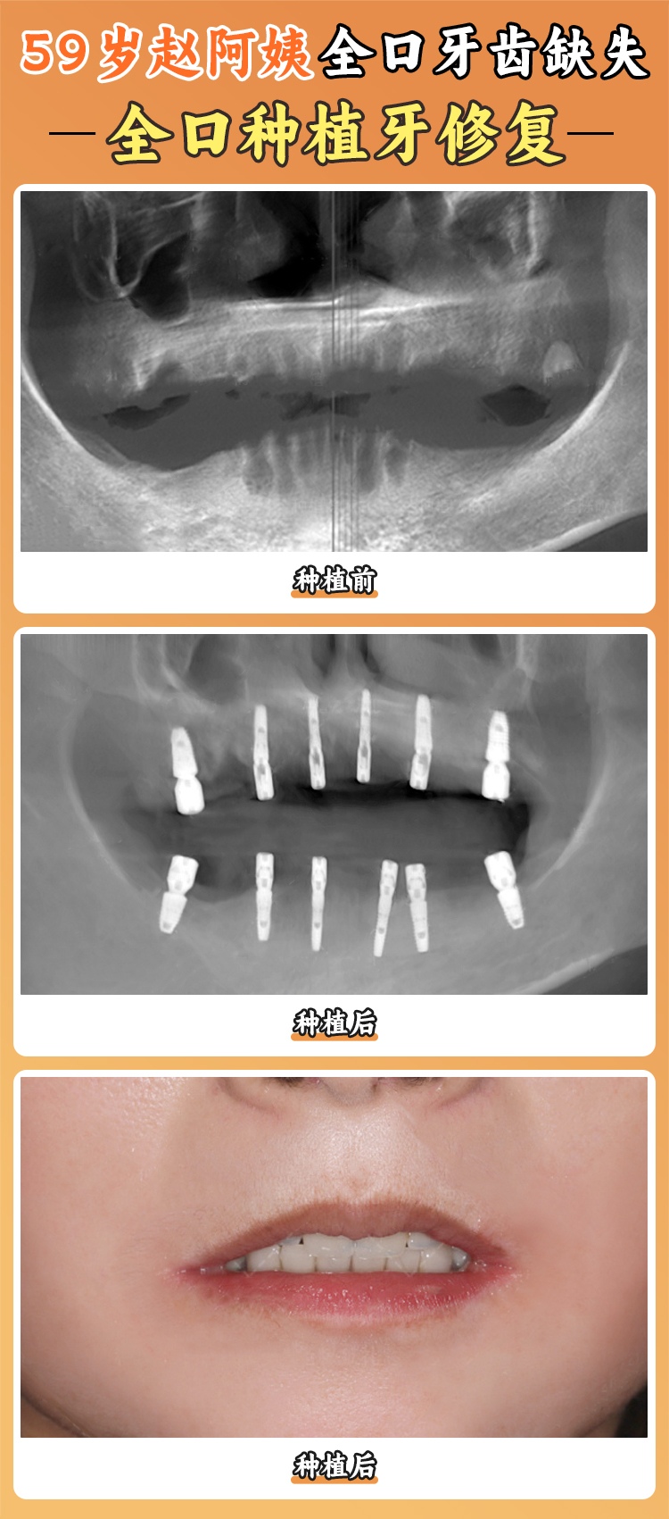 二、贝臣口腔医院种植牙的其他价格情况