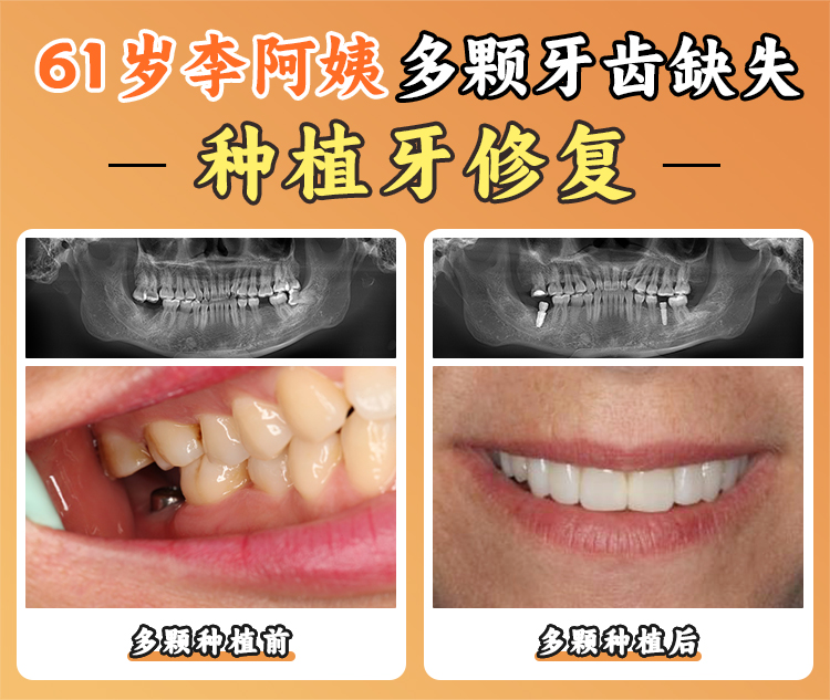 四、如何判断自己是否适合1800元的种植牙套餐