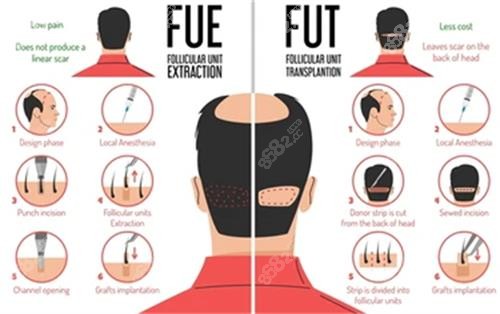 不同植发技术对比图解 不同植发技术对比图解