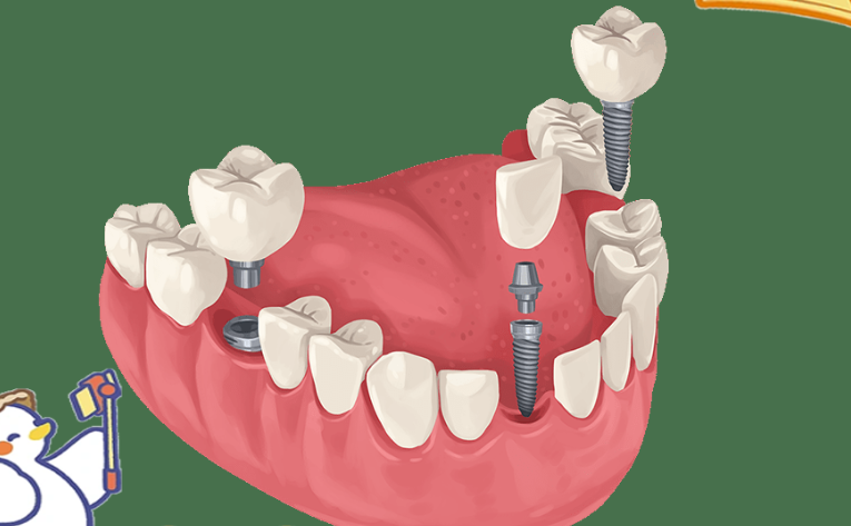 寧波應(yīng)彬彬醫(yī)生口碑怎么樣？應(yīng)彬彬做種植牙技術(shù)獲95%顧客好評