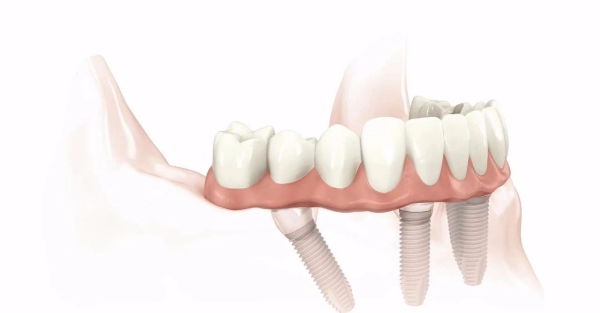 應(yīng)彬彬醫(yī)生種植牙