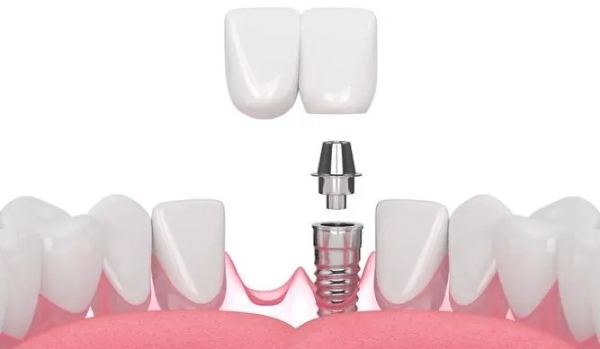 應(yīng)彬彬醫(yī)生種植牙