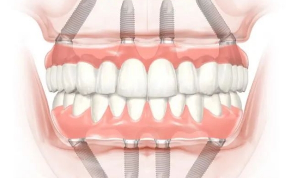 應(yīng)彬彬醫(yī)生種植牙