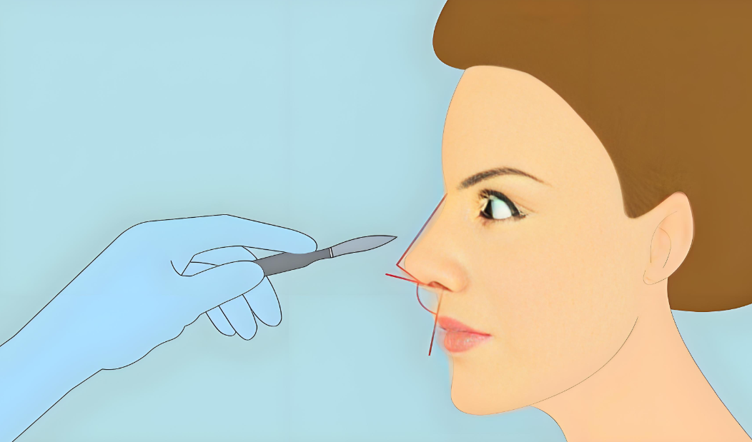 韓國do鼻子微調(diào)怎么樣