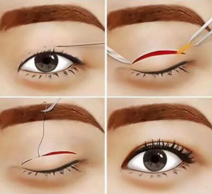 盧玲修復(fù)40歲左右雙眼皮怎么樣