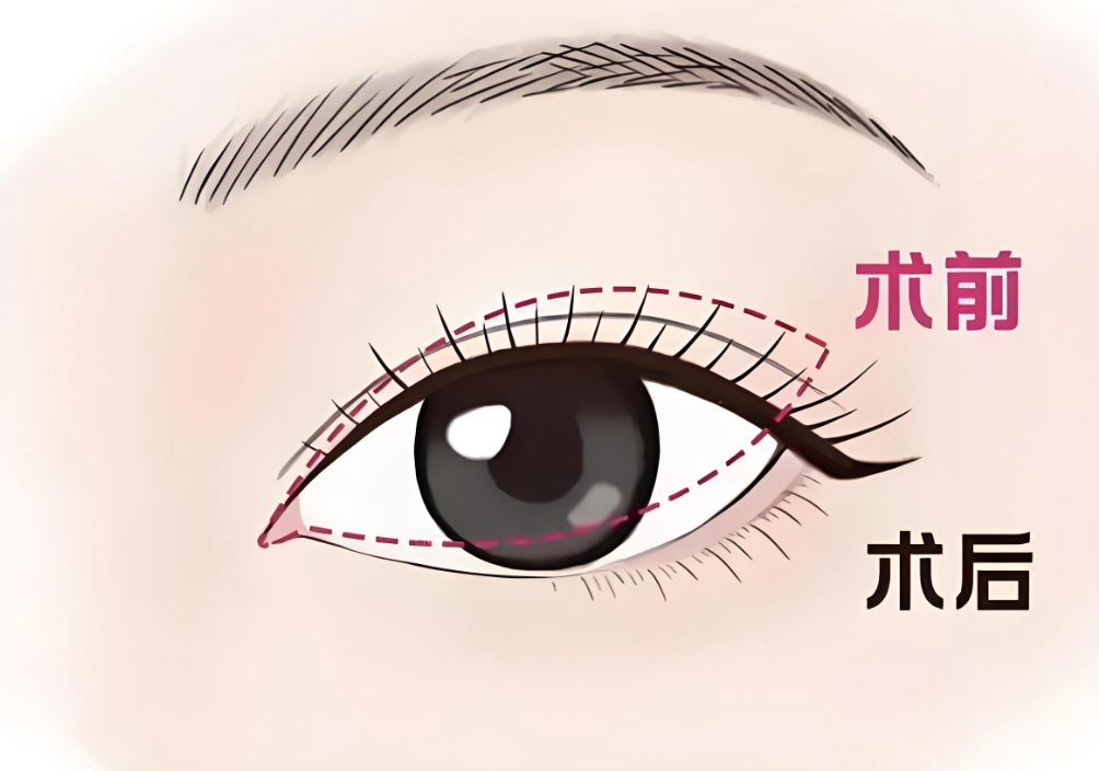 盧玲修復(fù)40歲左右雙眼皮好不好