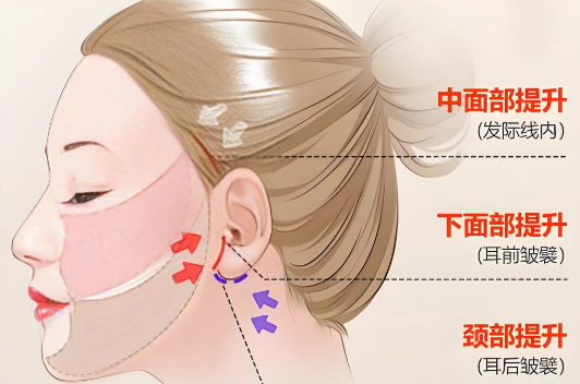 朱自剛面部提升三件套好不好www.66ub.cn