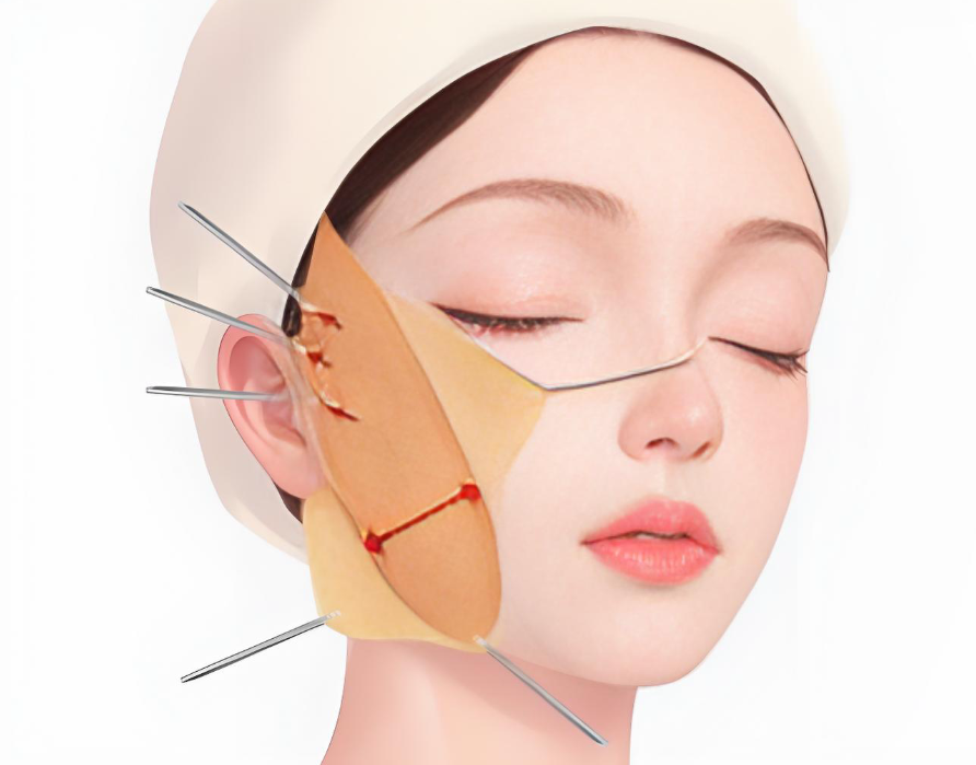 40+抗衰新選擇！張路整形筋膜提升小拉皮三件套：微創(chuàng)3天復(fù)工，功效維持5年+