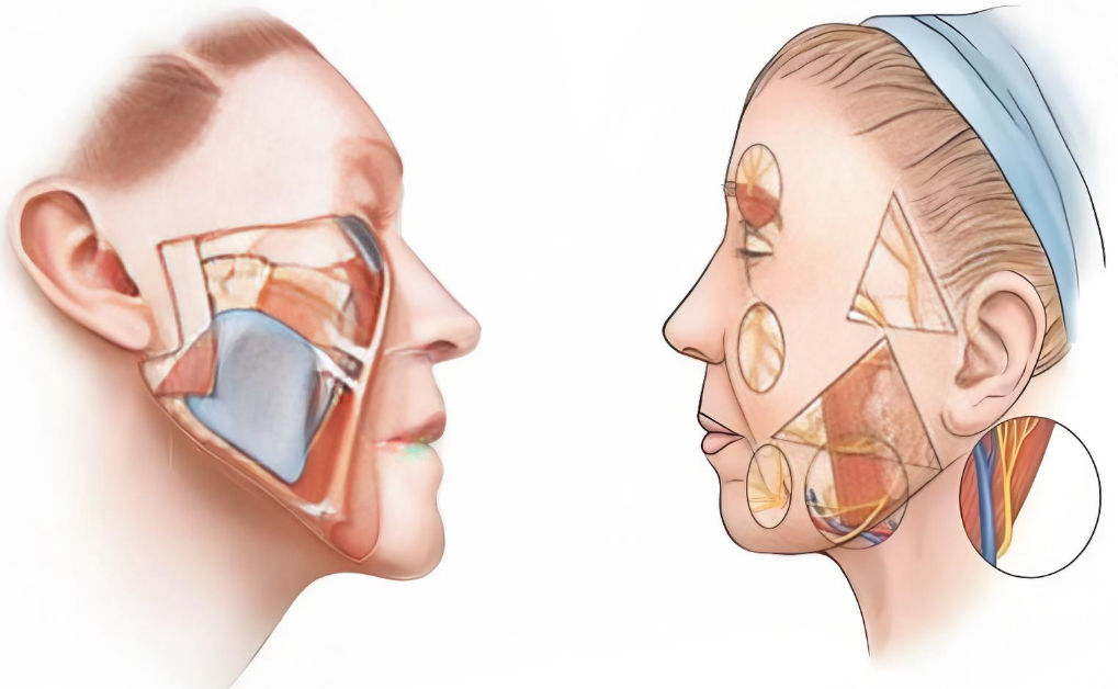 張路整形筋膜提升小拉皮三件套實(shí)例