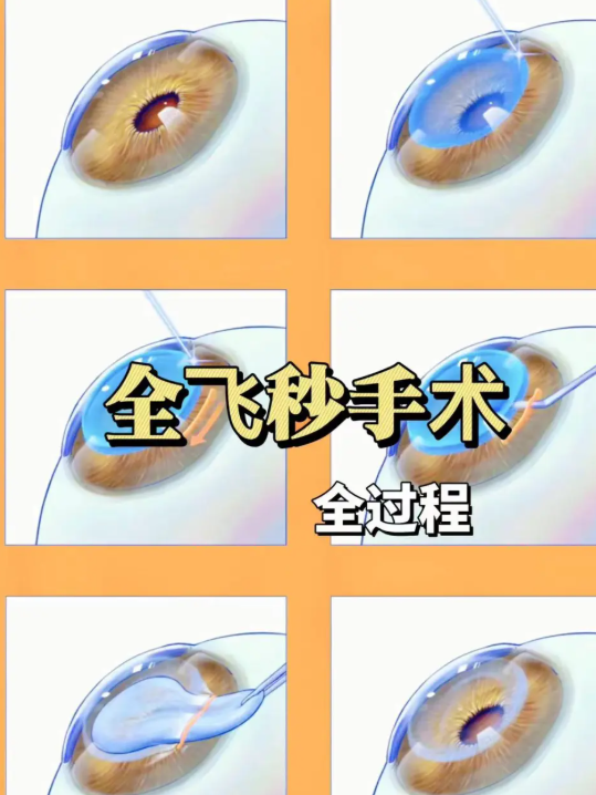 吉林華正眼科近視手術(shù)全飛秒