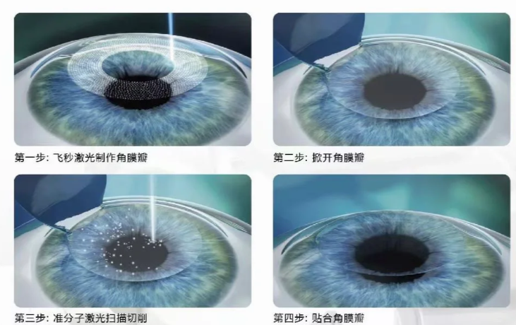 本地人必看:為什么選吉林華正眼科做近視手術(shù)?3個真實問題解答