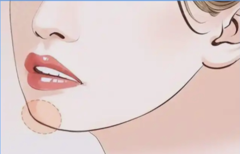 杭州玻尿酸下巴