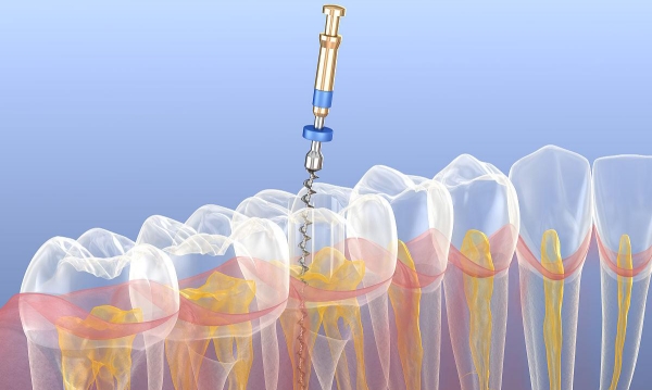 德倫口腔根管治療收費(fèi)價(jià)格表m.66ub.cn