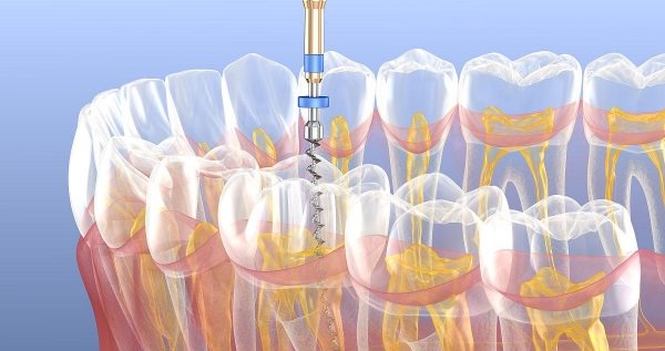德倫口腔根管治療收費(fèi)價格表：二次根管1200元起，含尖牙和后磨牙費(fèi)用對比