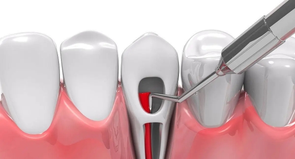 德倫口腔根管治療