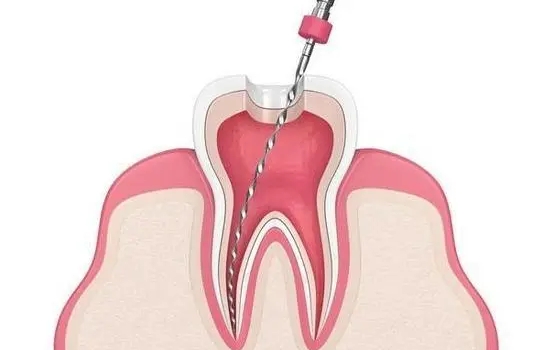 德倫口腔二次根管治療價(jià)格