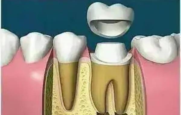德倫口腔全牙位根管治療可選額外費(fèi)用