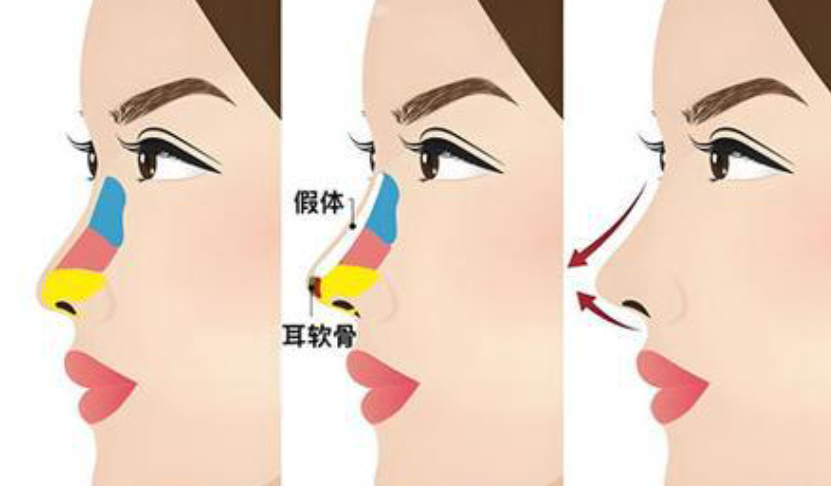 杭州李保鍇做鼻子多少年了？李保鍇有20年鼻整形經(jīng)驗(yàn)-鼻修復(fù)口碑好