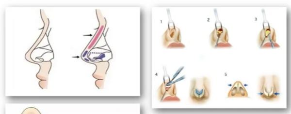 李長富隆鼻黑歷史？查了一圈，暫無實錘黑料但變好周期在3個月左右喲