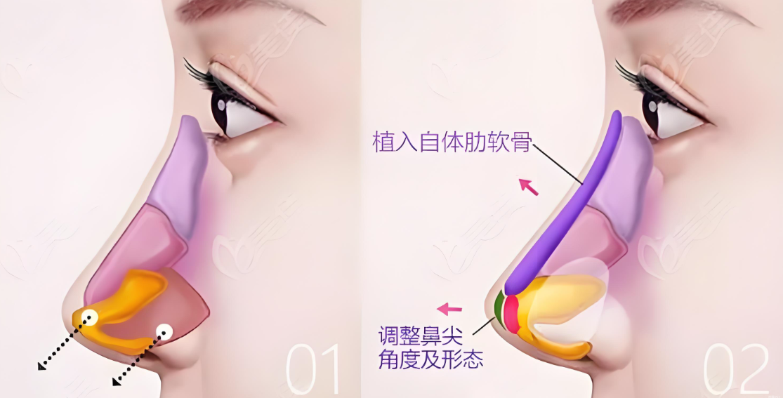 找深圳王天国修复鼻子怎么预约