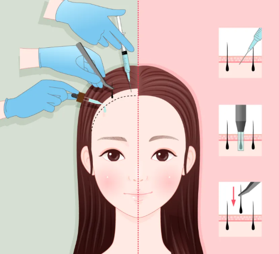 国内植发医院排名前十名榜单