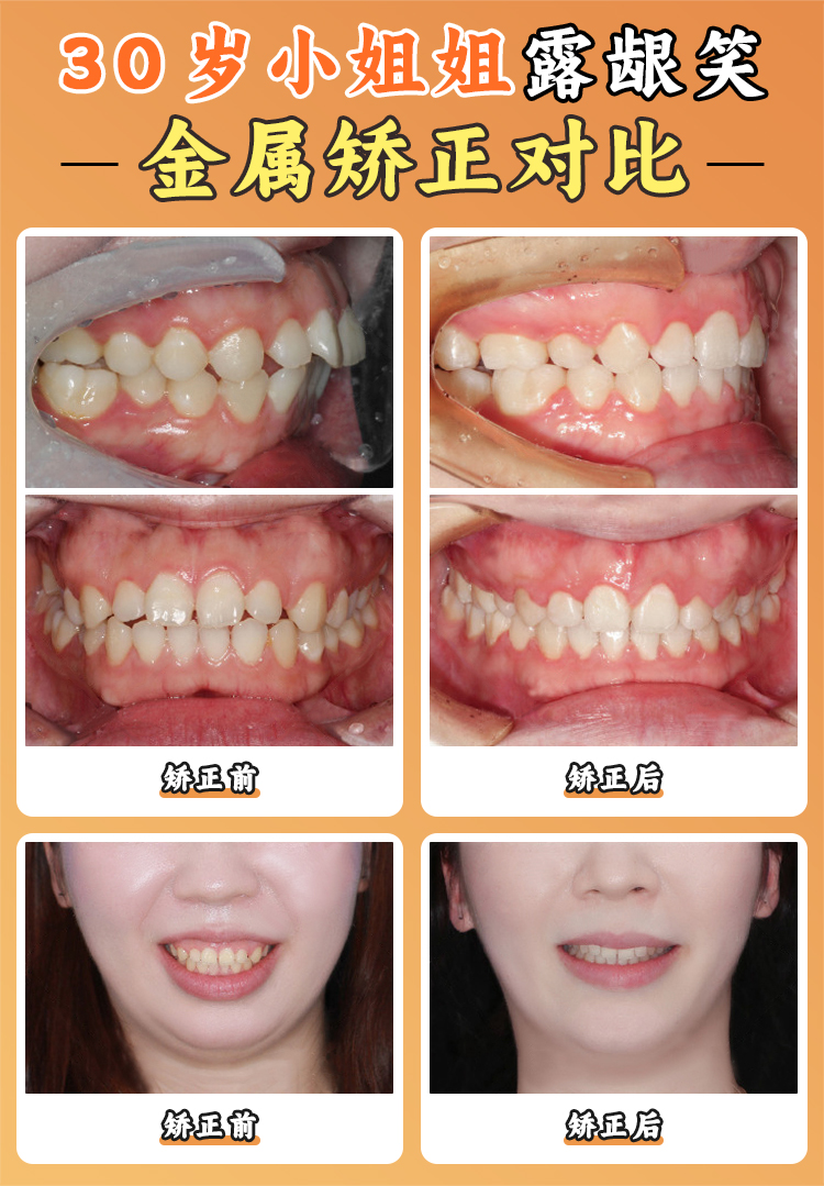 三、西安團(tuán)圓口腔醫(yī)院張保平醫(yī)生 3H + 技速戴種植技術(shù)