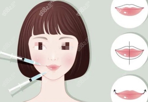 20251103172973.jpg 豐唇注射前后示意圖.jpg