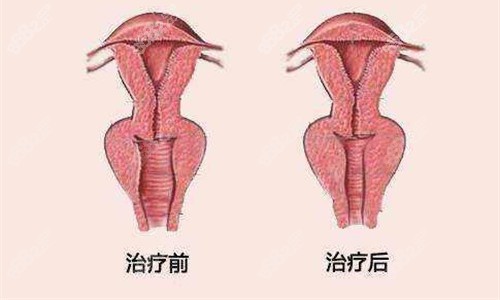 20251103511417.jpg 私密治療對(duì)比圖.jpg