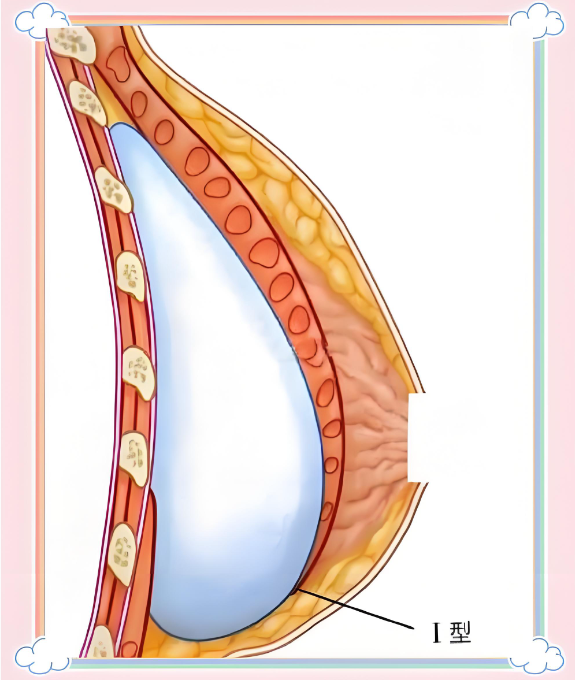 韓國(guó)隆胸20萬一個(gè)假體