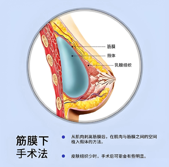 韓國(guó)隆胸20萬假體貴嗎