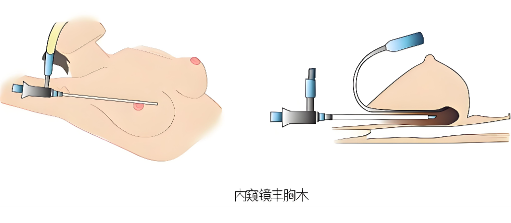 韓國(guó)隆胸20萬m.66ub.cn