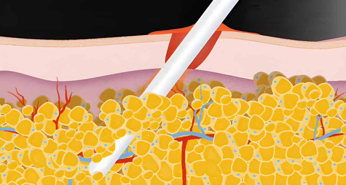 王世虎吸脂用的什么方法