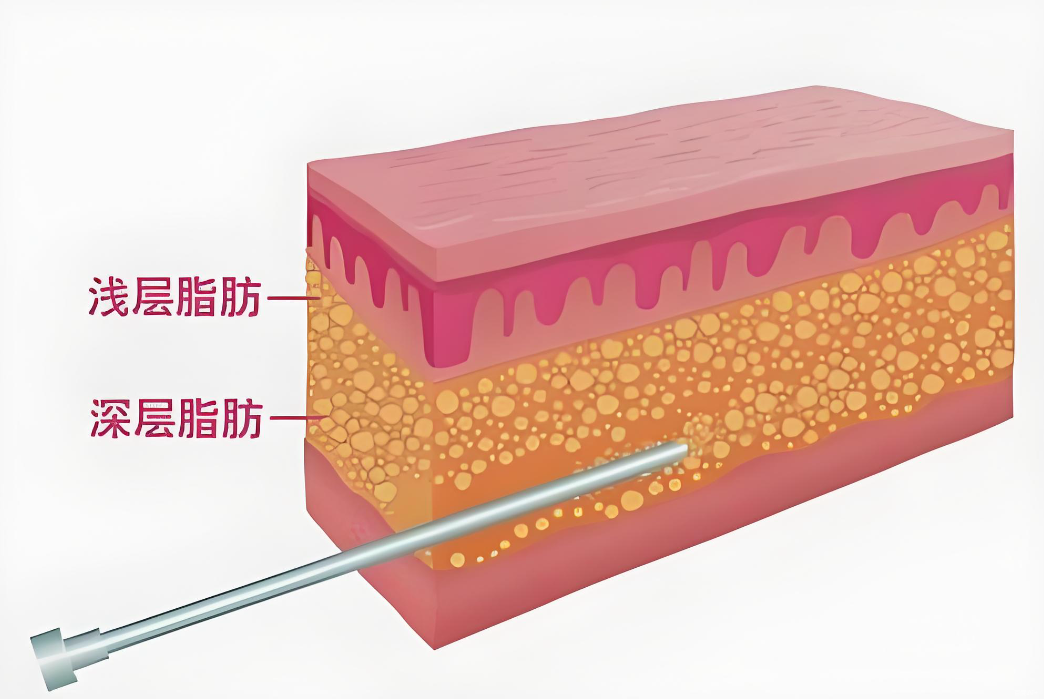 王世虎吸脂价格www.8682.cc
