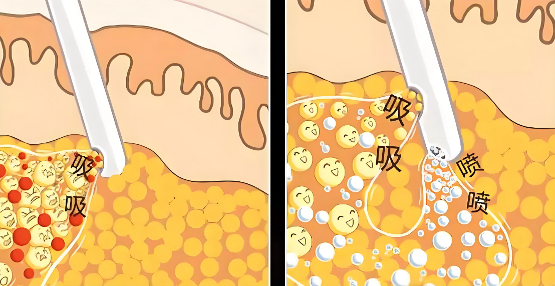 何斌张鹏吸脂哪个好