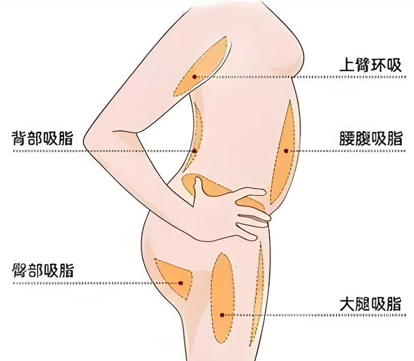 何斌和张鹏吸脂如何选www.8682.cc