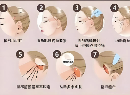 北京王易彬钻石网面部提升维持多久