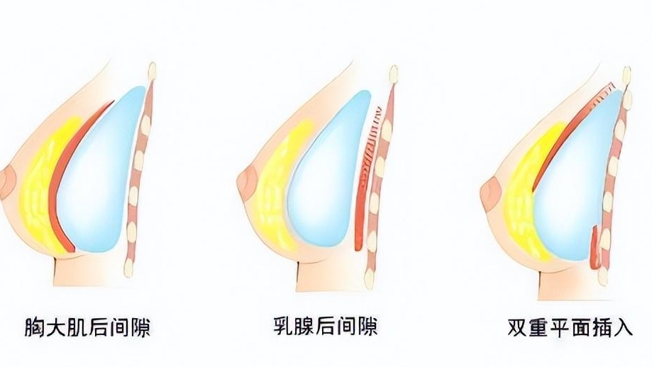 唐志荣隆胸项目注意事项
