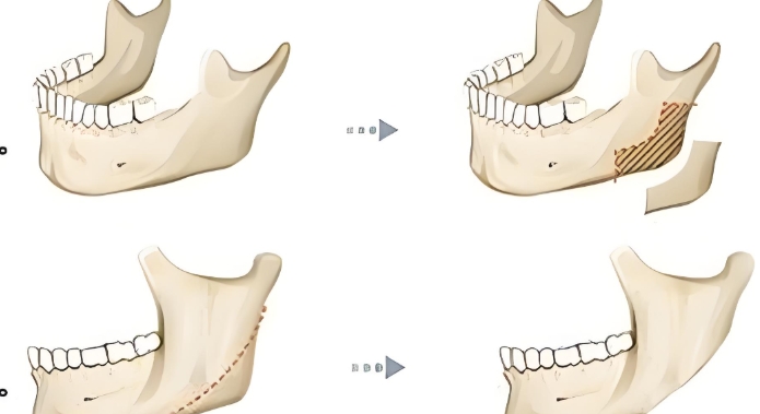 李运峰磨骨价格差异原因